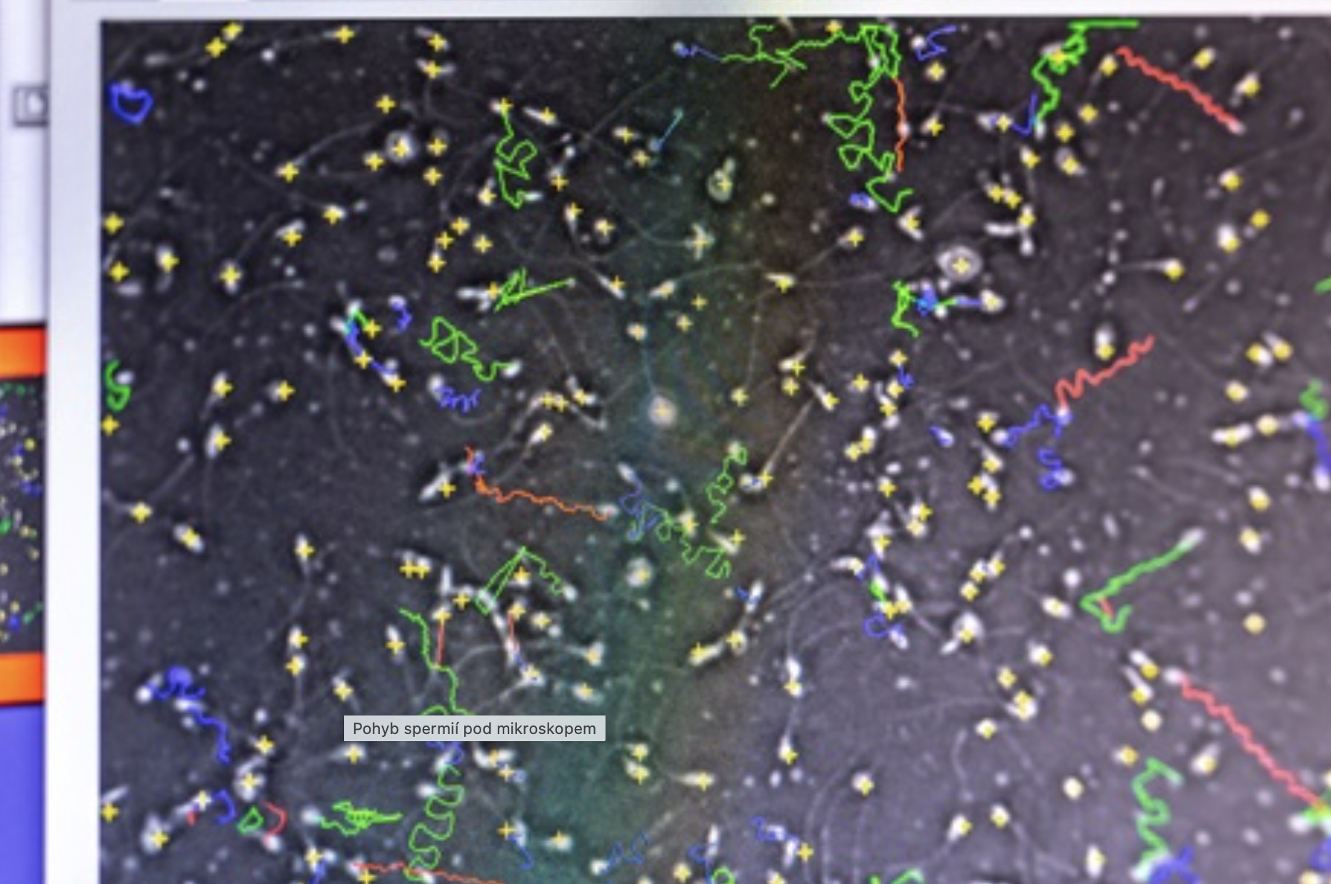 Dnes pokročilé techniky dokážou pomocí počítačové analýzy mikroskopického obrazu zaznamenat i trajektorie pohybu spermií AVCR spermie2