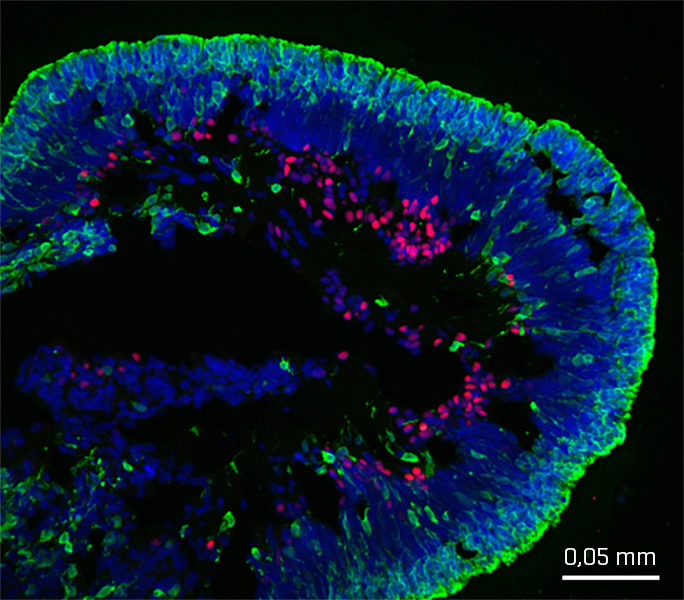 Dedicna slepota Retinalni organoid