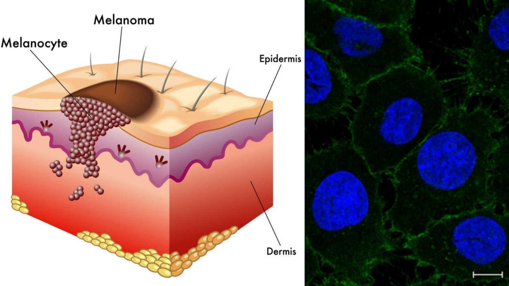 Grafické znázornění kožního melanomu + fotografie nádorových buněk z fluorescenčního mikroskopu melanom bunky 1 1024x576
