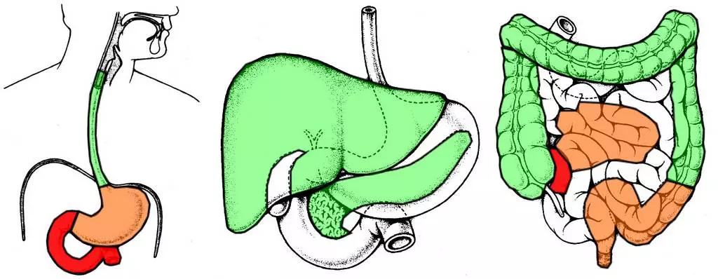 crohnova choroba semafor