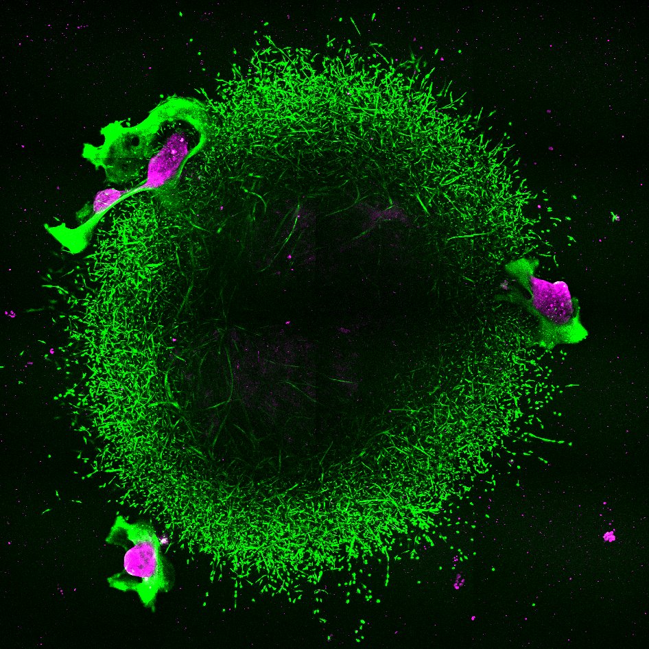 3D vyobrazení nádoru (růžová barva) napadající zdravý plicní organoid (zelená barva) Vzorek nádoru byl získaný od pacienta, snímek pořízen konfokálním mikroskopem v ICRC soraia1 vyobrazeni nadoru
