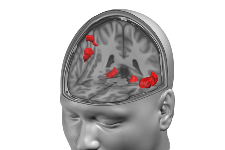 Srovnání objemu šedé hmoty: civilisté zasažení válkou vs. kontrolní skupina. Červeně oblasti se signifikantním rozdílem.