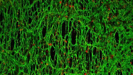 Interakce nanočástic (zobrazeny červeně) s extracelulárním matrixem (zobrazen zeleně) produkovaným fibroblasty spojenými s nádorem. Snímek byl pořízený konfokálním mikroskopem na University of Melbourne. soraia3 nanocastice
